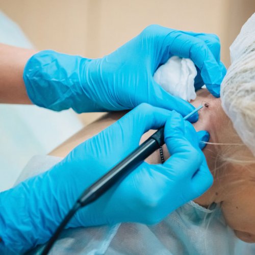 Удаление инородных тел без рассечения кожных покровов