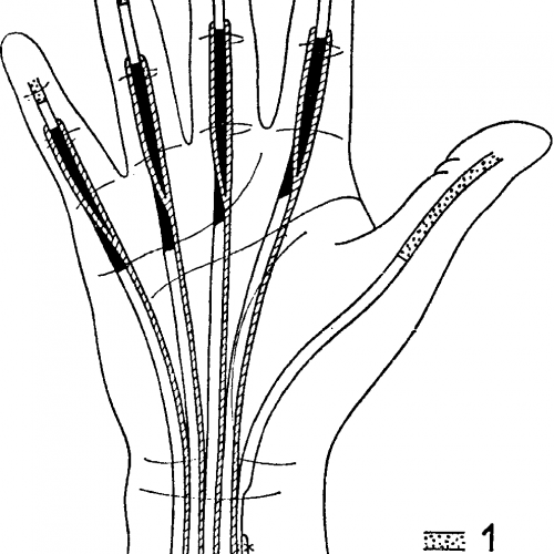 Восстановление сухожилий разгибателей кисти (без стоимости медикаментов)