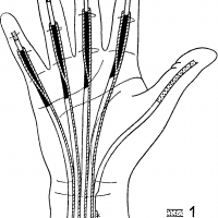 Восстановление сухожилий разгибателей кисти (без стоимости медикаментов)