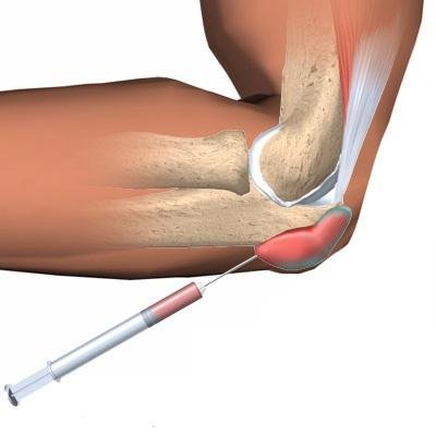 Удаление бурсы (без стоимости медикаментов)