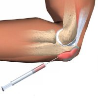 Удаление бурсы (без стоимости медикаментов)