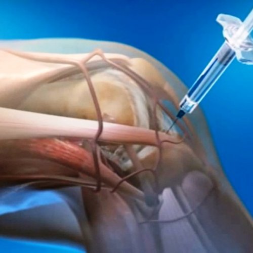 Пункция суставов (без стоимости медикаментов)