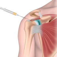 Аутоплазмалифтинг суставов (PRP-терапия)