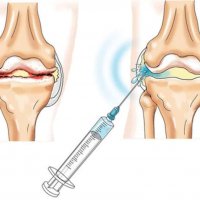 Внутрисуставное введение лекарственных средств (ревматолог)