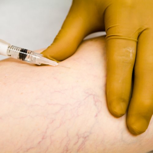 Склерозирование 1 ампула