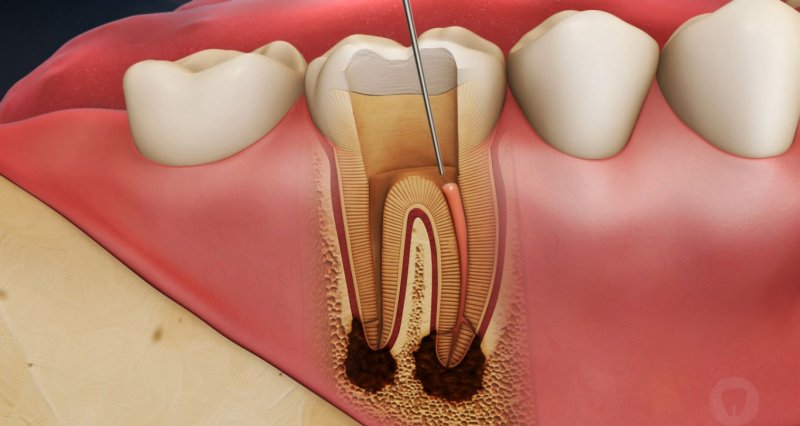 Лечение пульпита и периодонтита