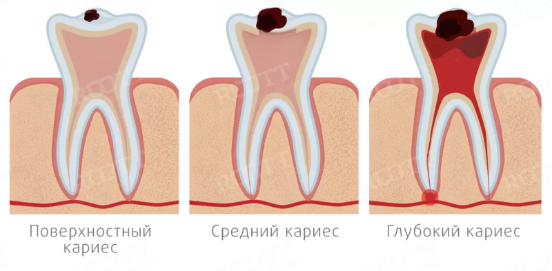 Комплексное лечение кариеса