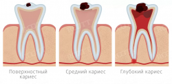 Комплексное лечение кариеса