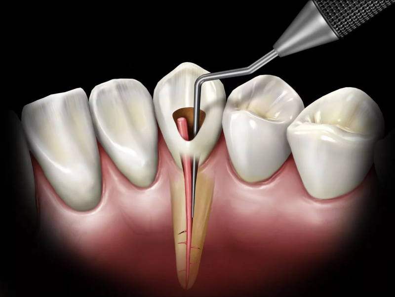 Лечение пульпита одноканального зуба