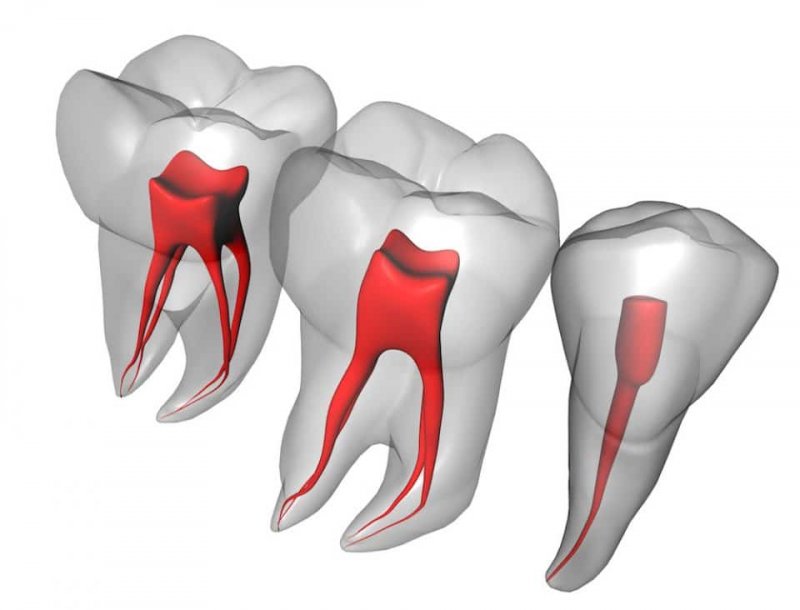 Лечение пульпита трехканального зуба