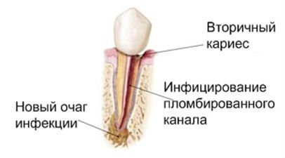 Лечение периодонтита одноканального зуба