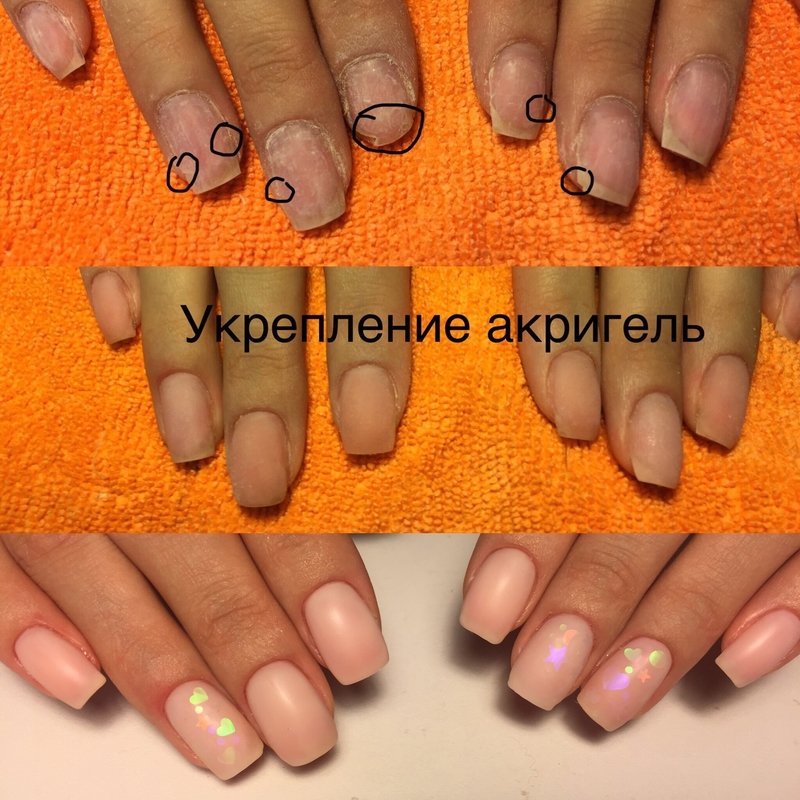 Укрепление акригелем