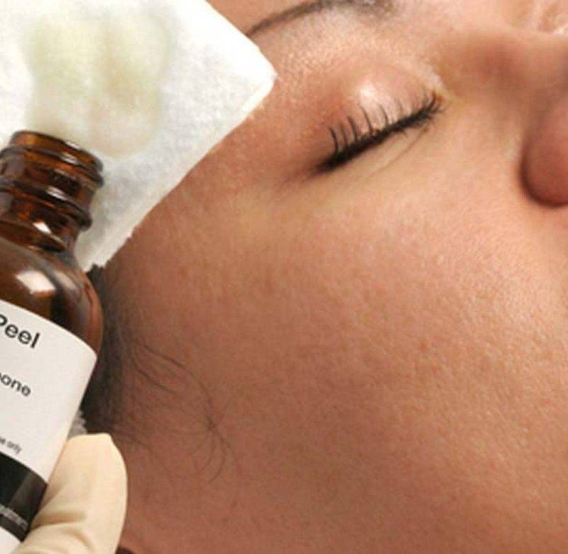 Пилинг Джесснера