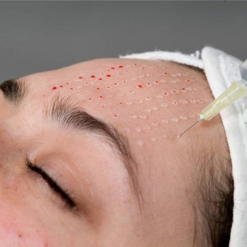 Биоревитализация