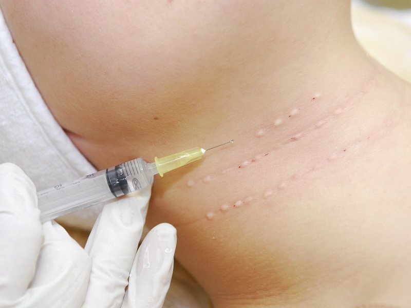 Биоревитализация шеи