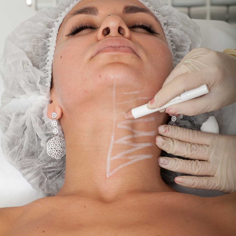 Биоревитализация шея+декольте