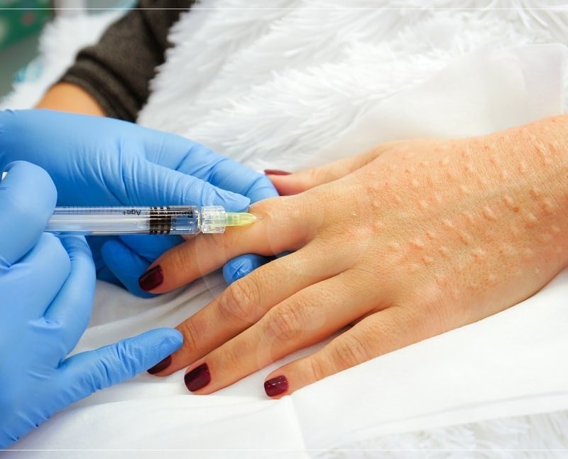 Биоревитализация рук