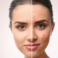 Мезотерапия «Anti акне»