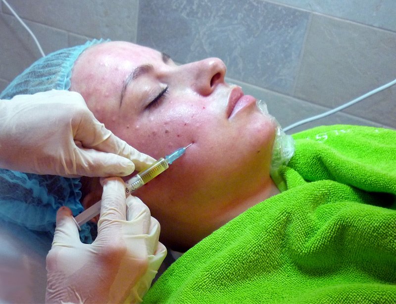 Плазмолифтинг лица