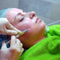 Плазмолифтинг лица