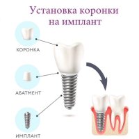 Циркониевая коронка на имплантат системы Osstem