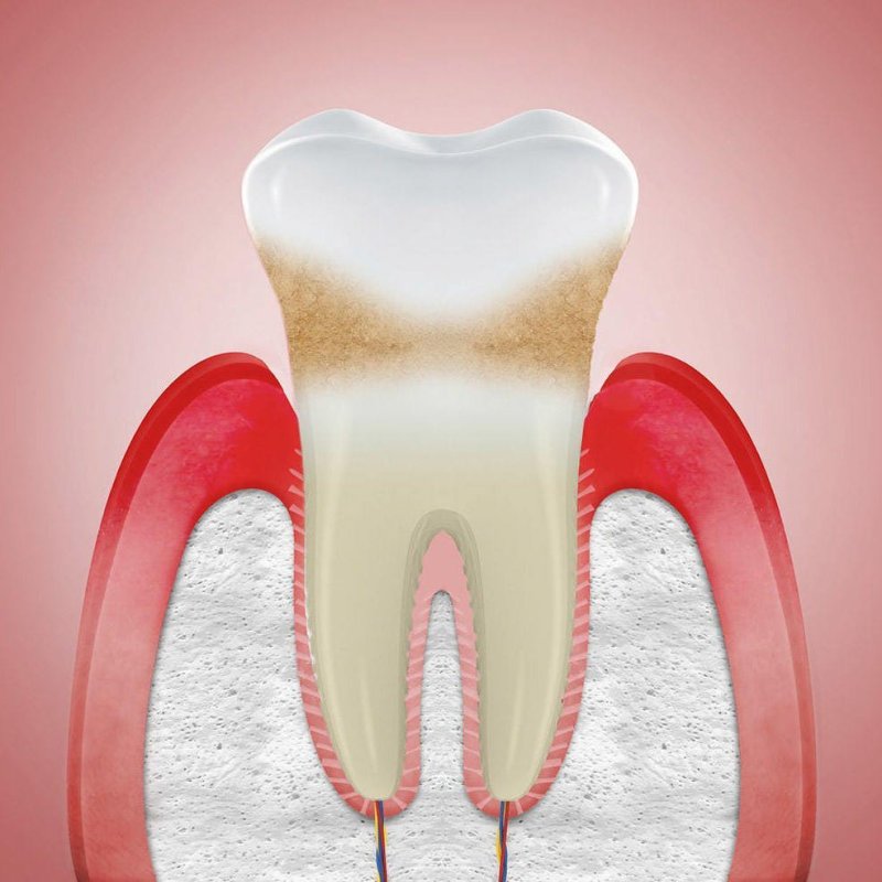 Периодонтит