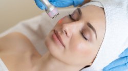 RF лифтинг лицо