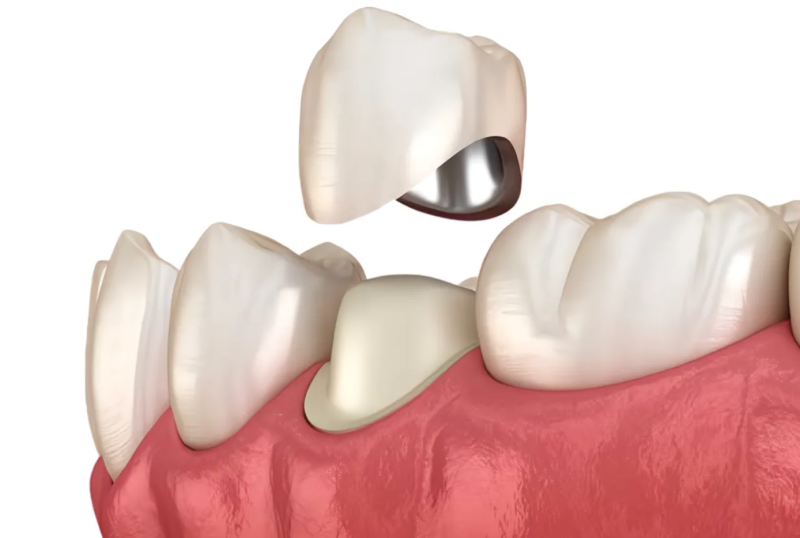 Коронка металлокерамическая