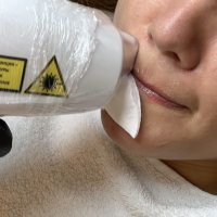 Лазерная эпиляция (Одна зона лица)