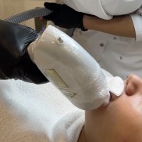 Лазерная эпиляция (Одна зона лица)