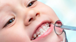 Лечение кариеса молочного зуба