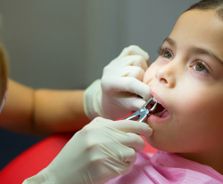 Удаление молочного зуба